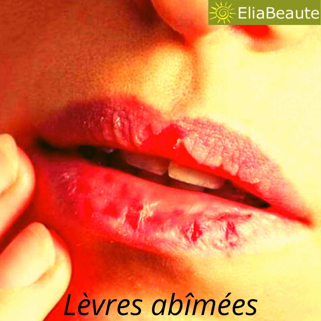 Des-levres-abimees | La beauté au naturel